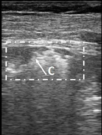 Lung Ultrasound Using Digi-Lite IP+™ - Rimed Ltd